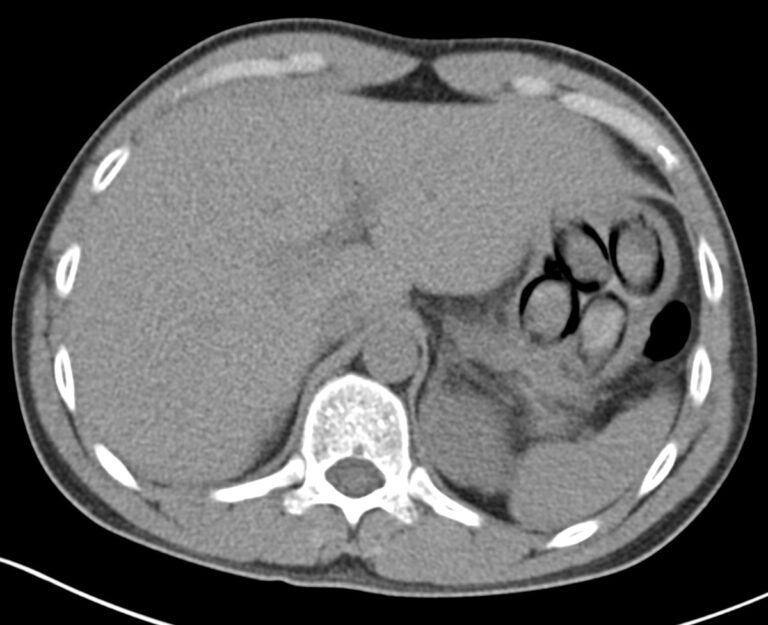 Nederlander betrapt met cocaïnebolletjes in zijn lichaam in internationale bus bij luchthaven Keulen/Bonn